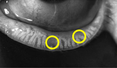 탈락하거나 퇴화한 마이봄샘 이미지