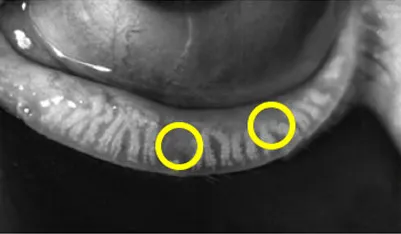 탈락하거나 퇴화한 마이봄샘 이미지