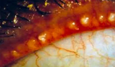 염증이 생겨 딱딱하게 굳은 기름샘 이미지