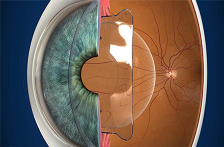 안내렌즈삽입술 후방렌즈 삽입 예시이미지