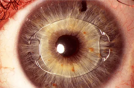 안내렌즈삽입술 전방렌즈 삽입 예시이미지