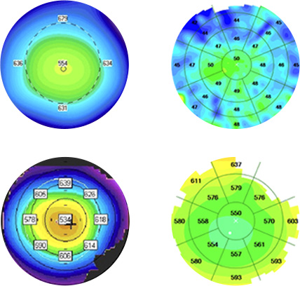 빛간섭단층촬영기 각막상피 두께 측정 결과 이미지 — 반복 측정을 통해 각막 두께를 정밀하게 분석하여 불필요한 각막 절삭을 최소화하고 잔여각막 보존율을 높이는 검사 방식.