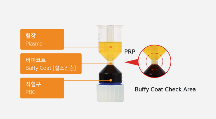 PRP 혈소판 풍부 혈장 분리 과정 이미지 — 원심분리를 통해 혈장(Plasma), 버피코트(혈소판층), 적혈구(PBC)가 구분되며, 버피코트 영역에서 고농축 PRP를 추출하는 과정을 보여줌.