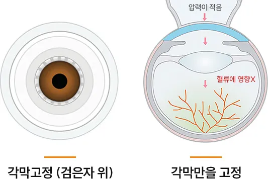 각막 고정 방식 이미지 — 비쥬맥스는 각막만을 고정해 혈류 변화 없이 안전하게 수술을 진행함.