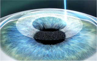 lasik_step1