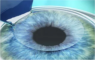 lasik_step2